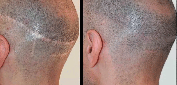 cuir chevelu d'un patient pris de profil avec a gauche les cicatrices d'une FUT et à droite le résultat après une tricopigmentation