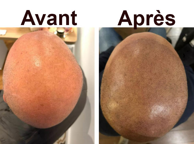 cuir chevelu vu du dessus d'un patient avant et après une séance de dermopigmentation capillaire