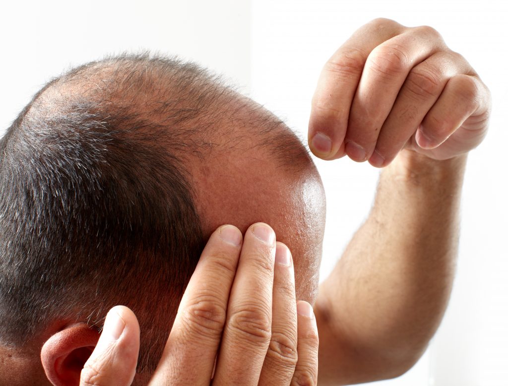 homme constatant une perte de cheveux après sa chirurgie d'implant capillaire