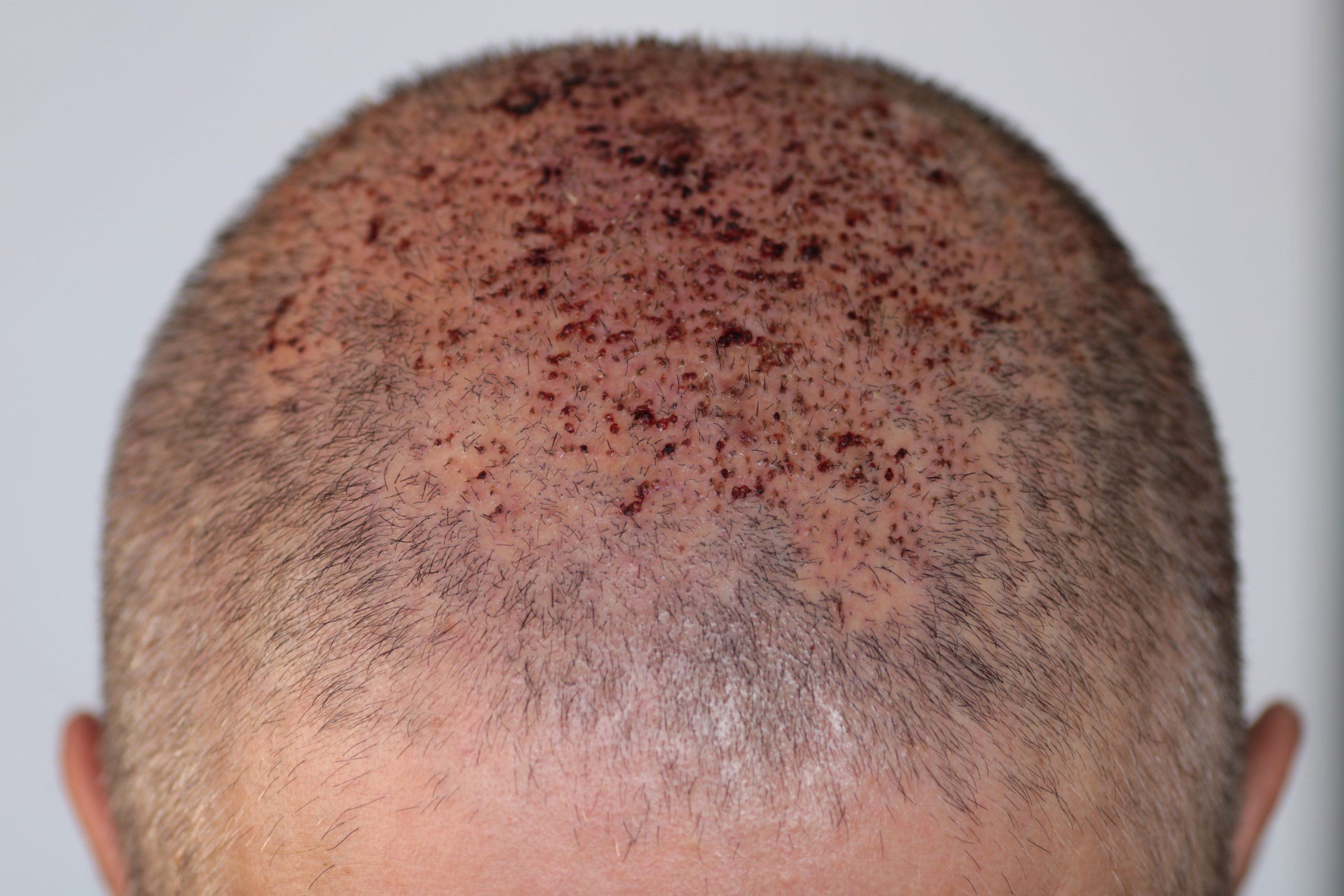 photo d'un crâne vu d'en haut avec des greffons en court de cicatrisation après une greffe de cheveux