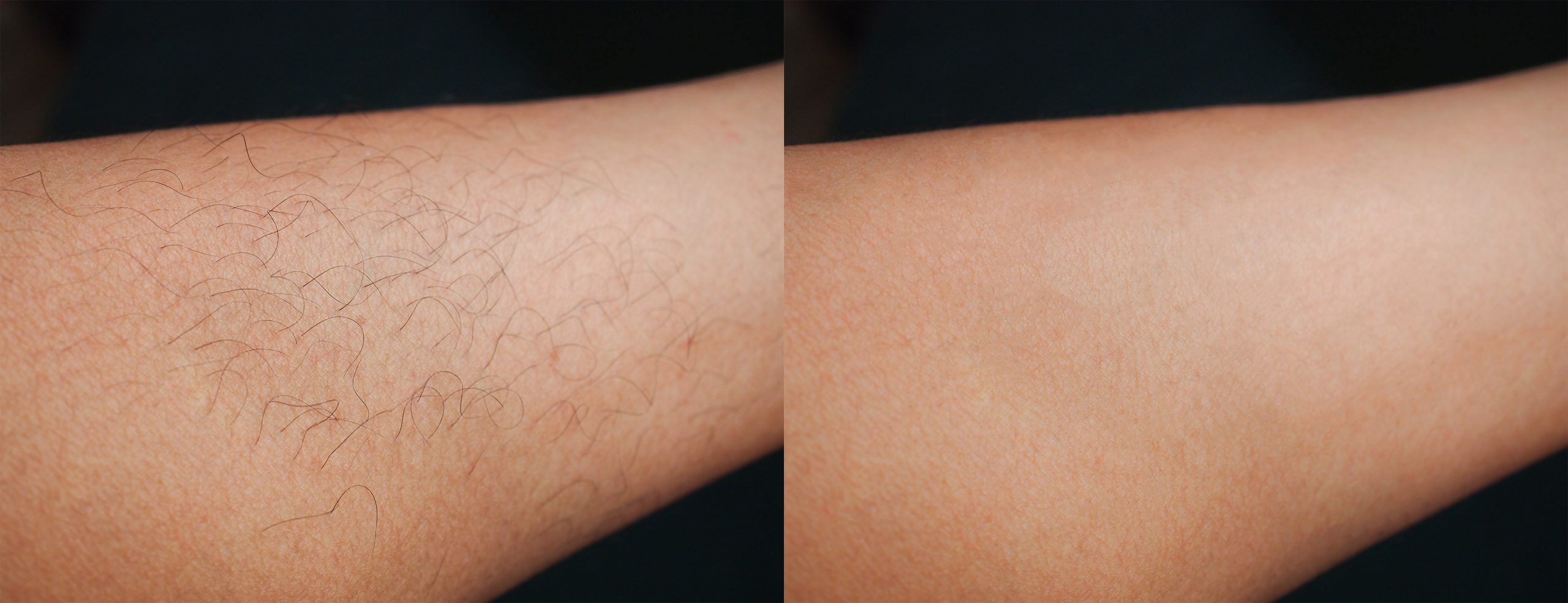 Epilation permanente Paris expérience client
