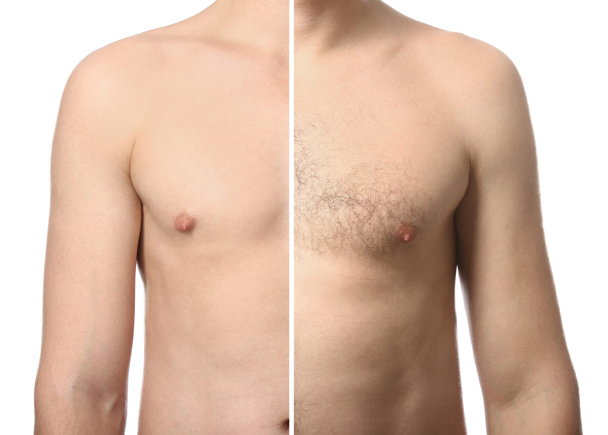 Epilation laser et IPL