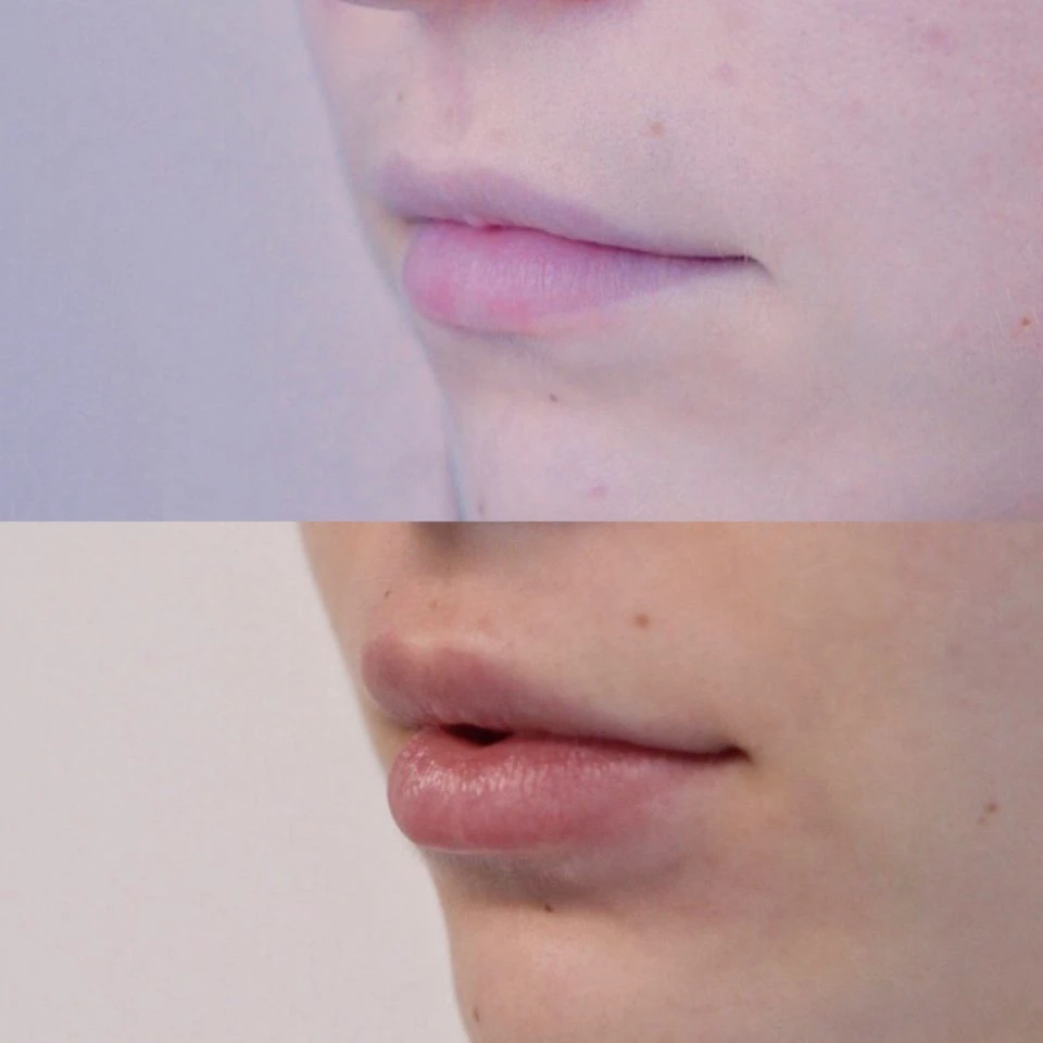 Grosses lèvres