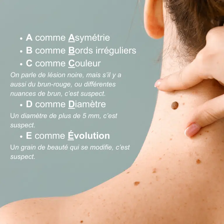 Grain de beauté ou mélanome ? Comment faire la différence Maison Marignan — free download
