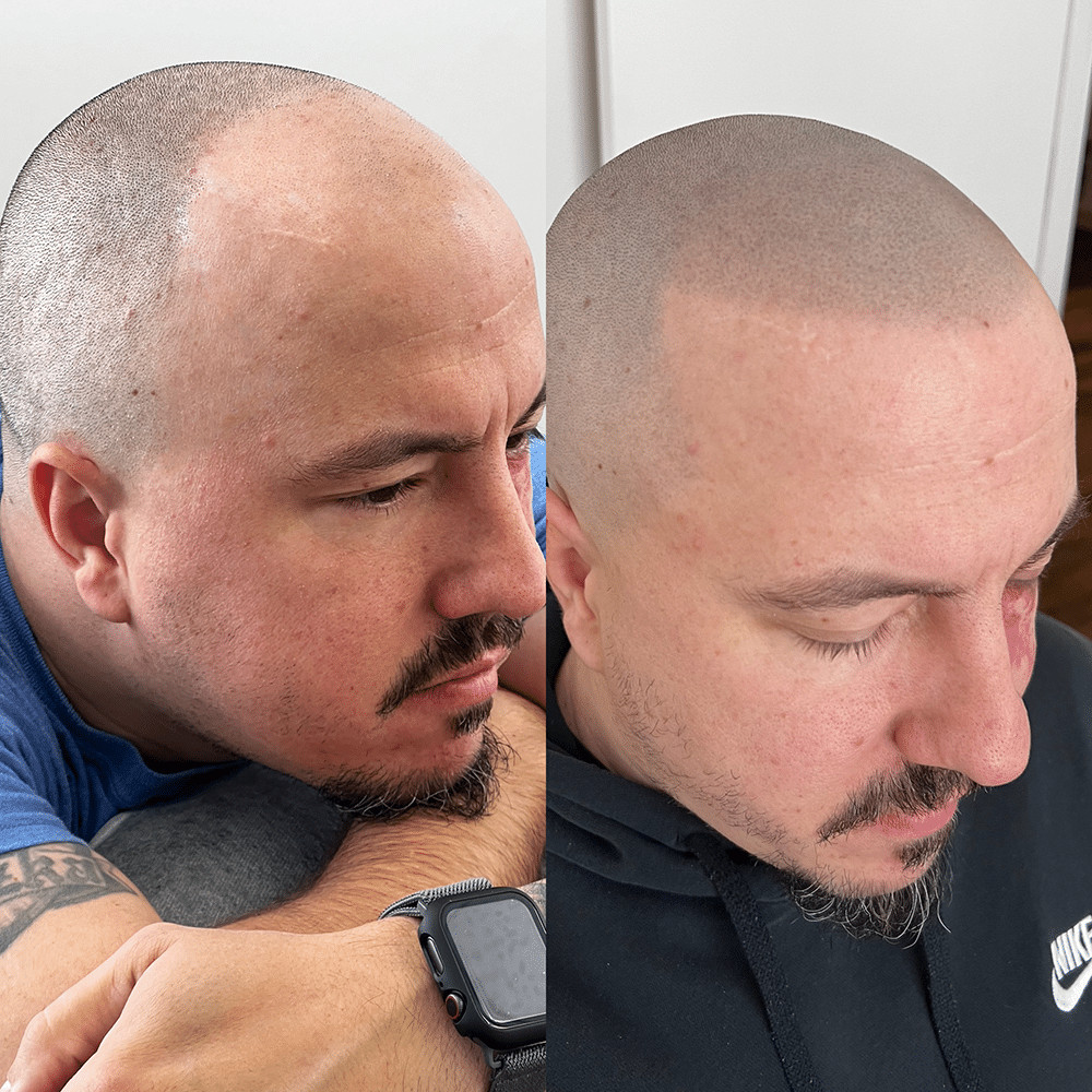 Résultats micro pigmentation capillaire