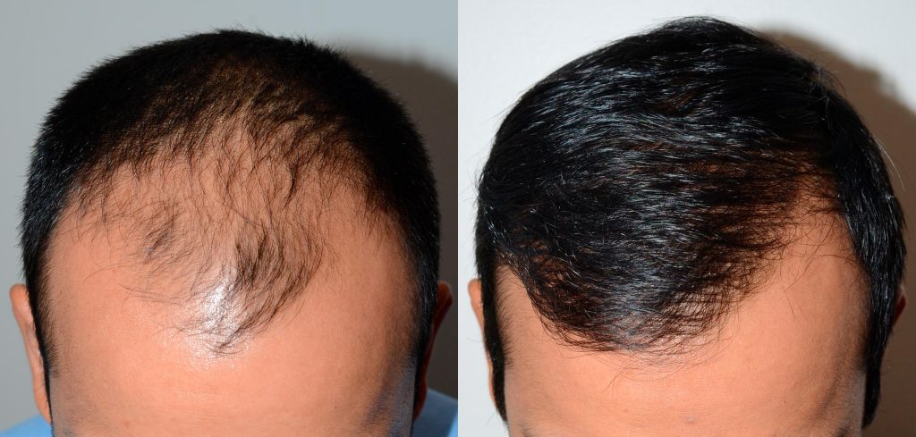Techniques greffe de cheveux