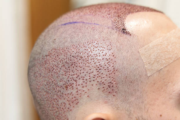 Cuir chevelu greffe de cheveux