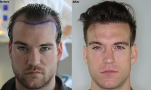 Raisons-choisir-Paris-greffe-de-cheveux
