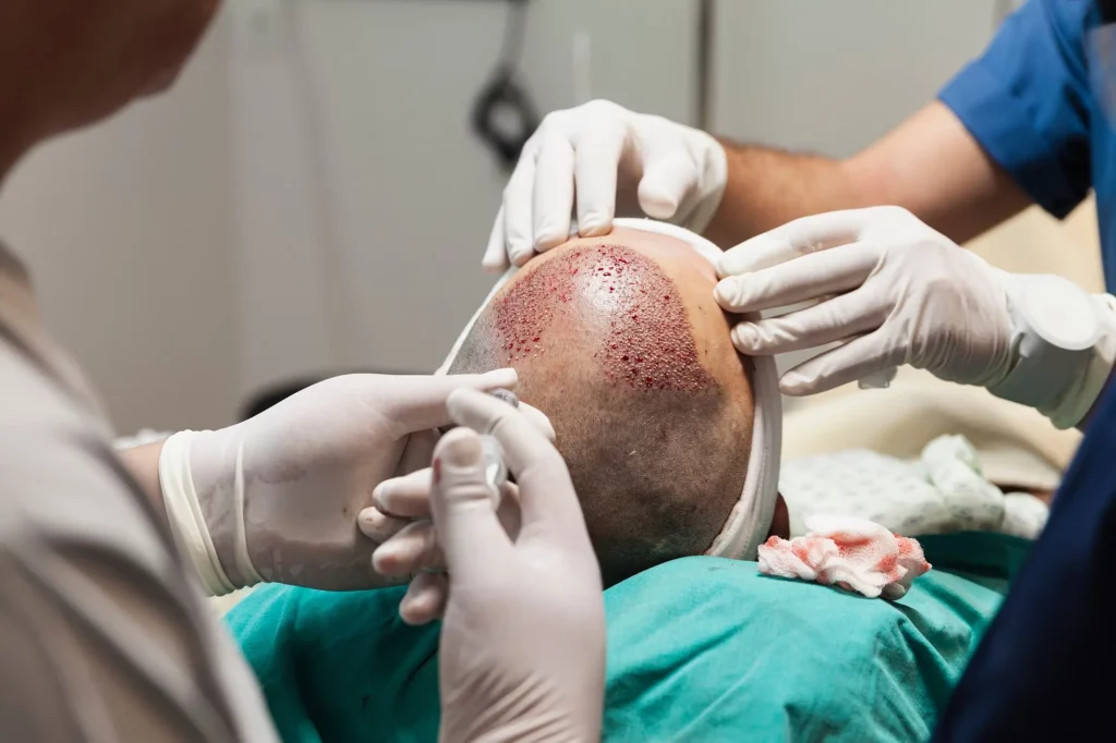 Technique greffe de cheveux
