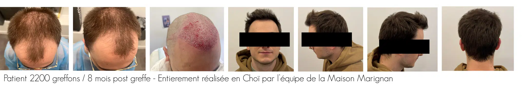 Photos d'évolution de patients - greffe CHOI