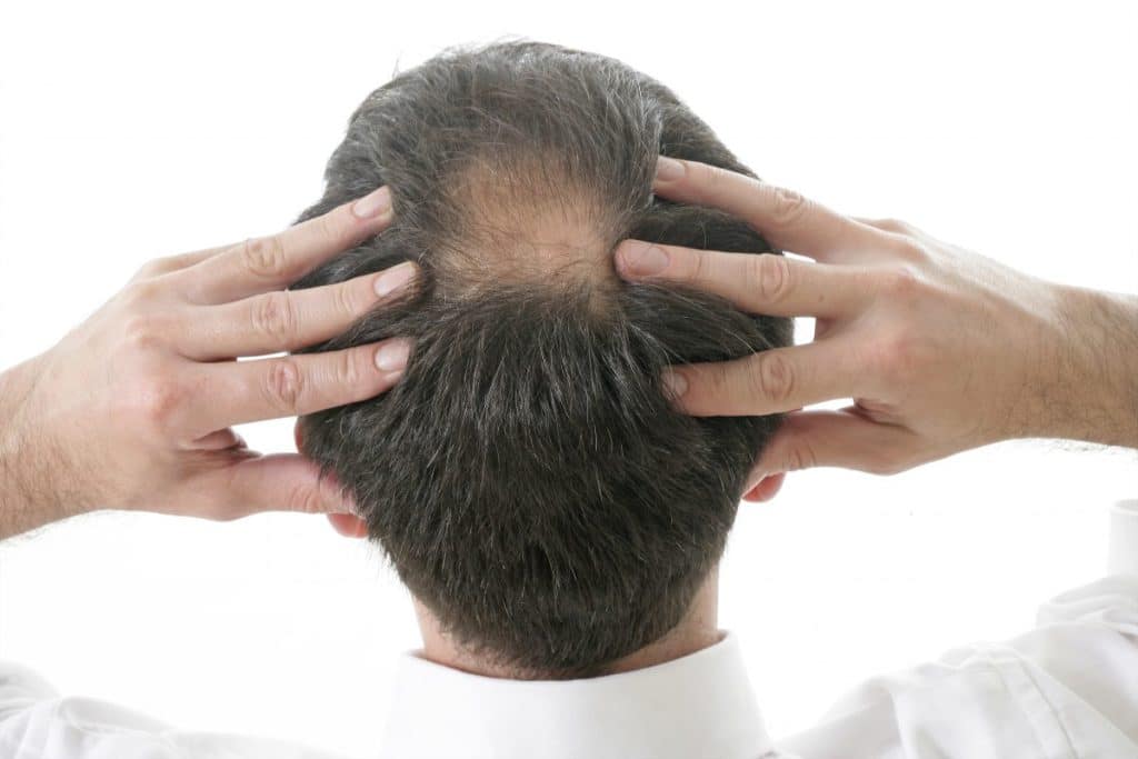 Patients-jeunes-alopecie-androgenetique-precoce