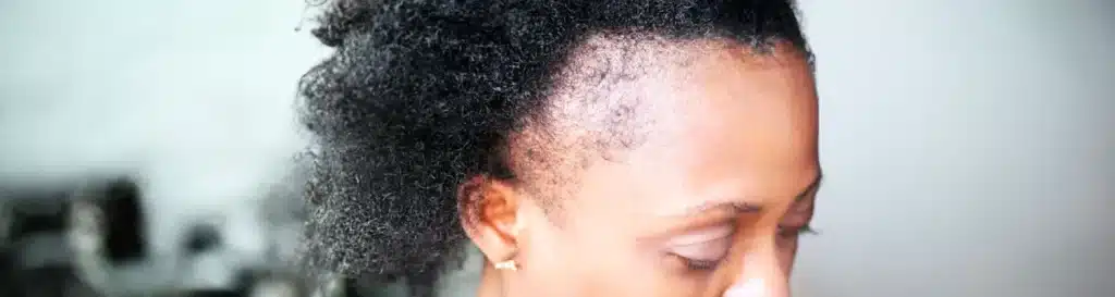Alopecie-de-traction-causes