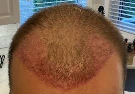 Combien-de-temps-faut-il-attendre-entre-deux-greffes-de-cheveux