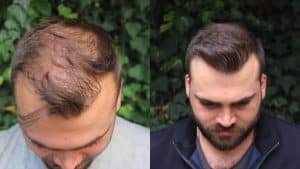 Greffe-capillaire-alopecie-de-traction