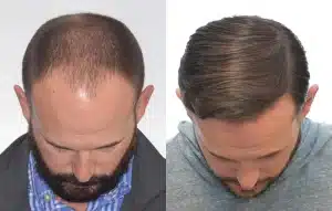 Cheveux-greffes-fins-annees