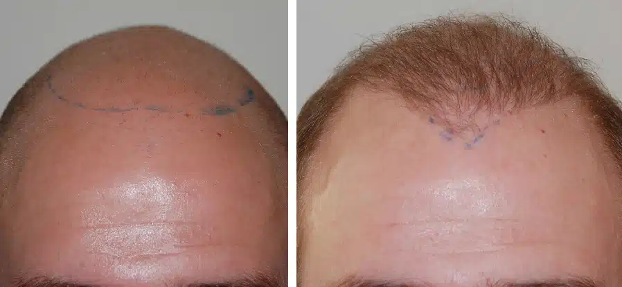 Implant-capillaire-6-mois-apres