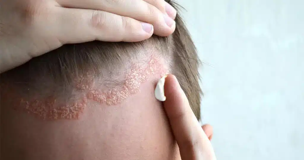 Maladies-inflammation-cuir-chevelu