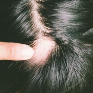 Micro-inflammations-cuir-chevelu-greffe-de-cheveux