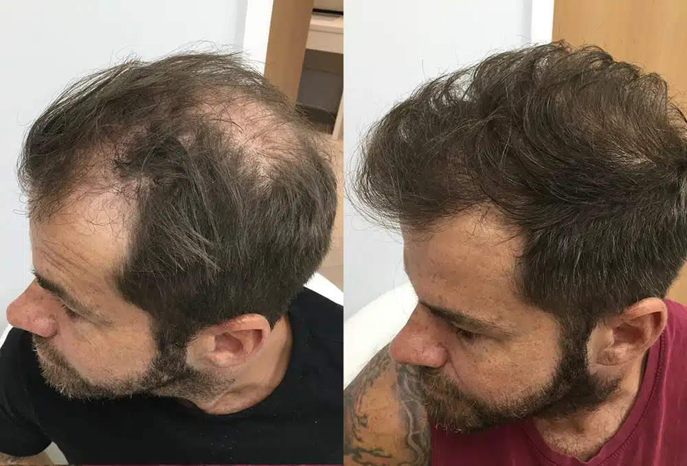 Résultats avant après greffe cheveux Paris - Galerie Maison Marignan