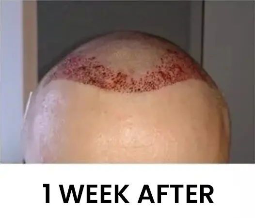 Phase-des-cheveux-perdus-greffe-capillaire
