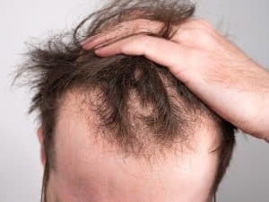 Que-faire-quand-perd-cheveux-tres-jeune