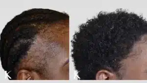 Cheveux-afro-greffe-capillaire-technique-choi