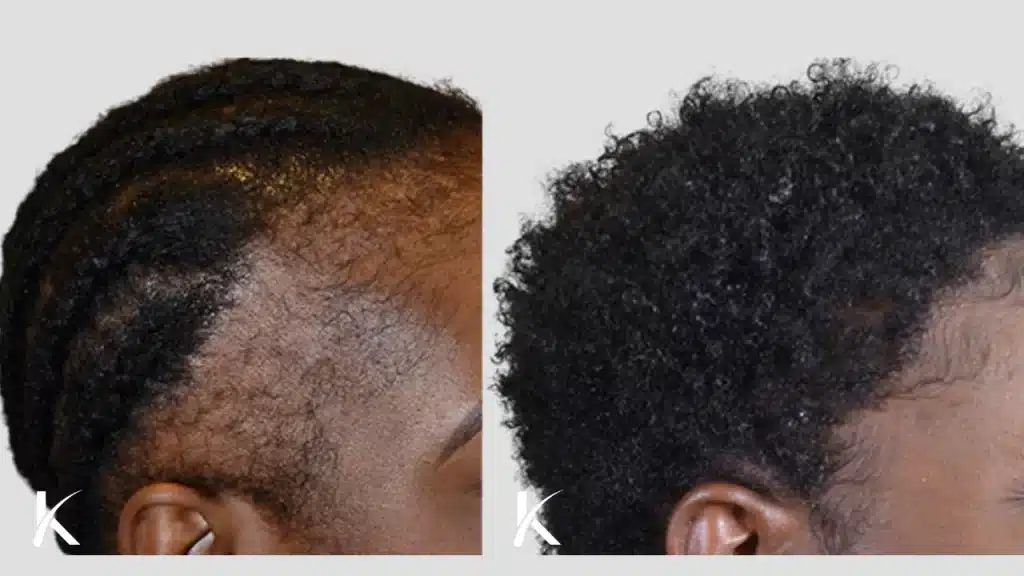Cheveux-afro-greffe-capillaire-technique-choi