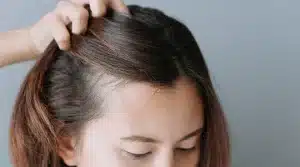 Perte-de-cheveux-apres- accouchement-greffe-de-cheveux