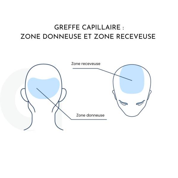 Schéma zones donneuse et receveuse greffe capillaire - Maison Marignan Paris