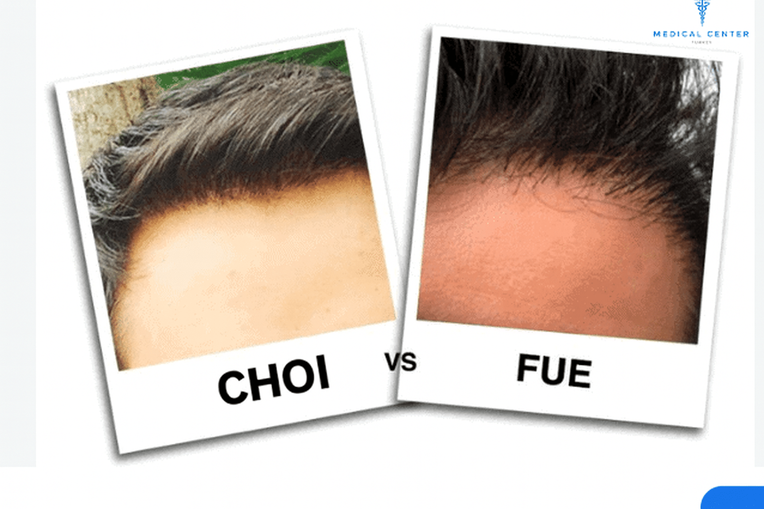 Comparaison technique CHOI vs FUE greffe cheveux Paris