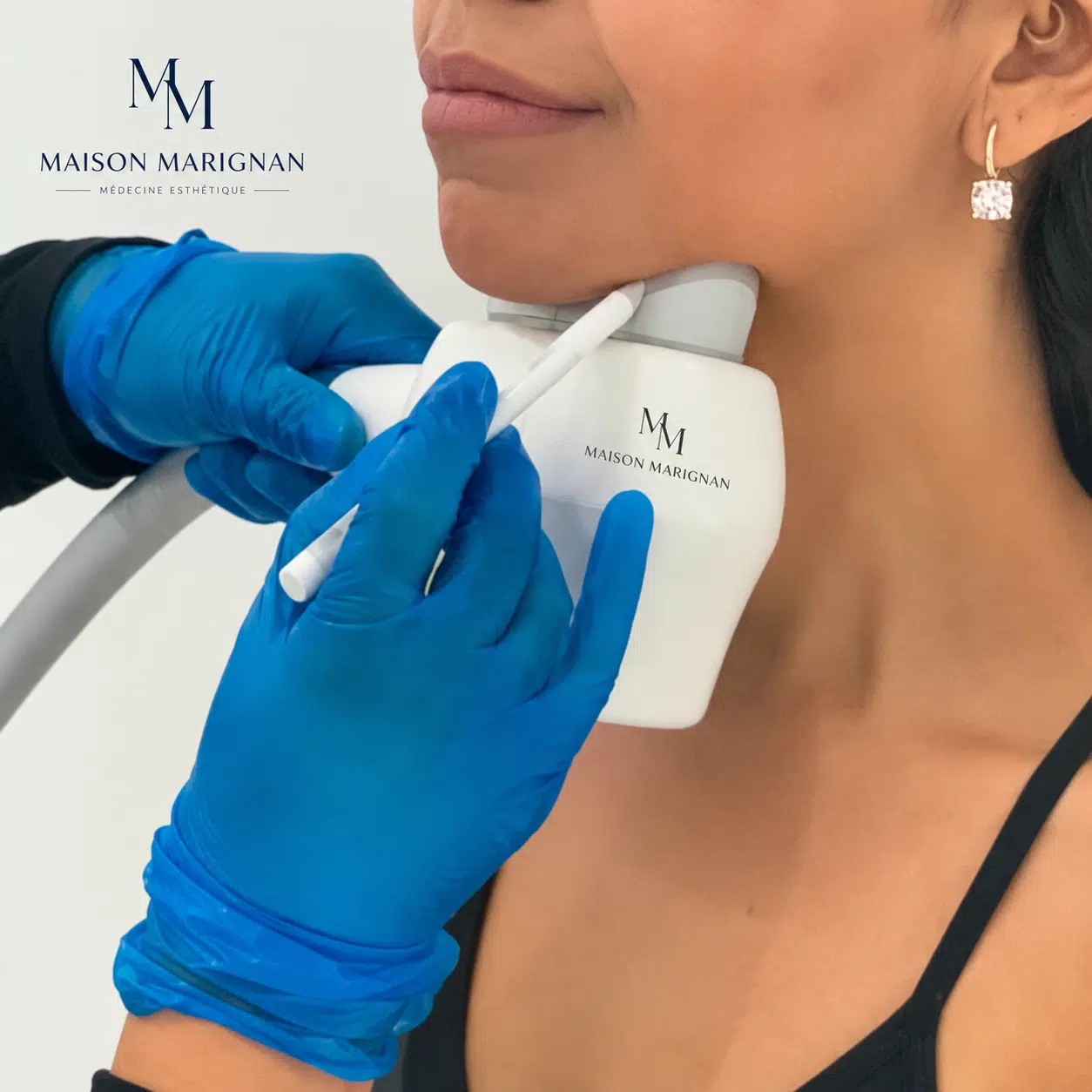 Cryolipolyse du double menton résultat — Maison Marignan Paris