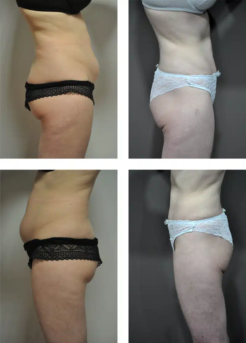 Cryolipolyse ventre femme avant/après — Maison Marignan Paris