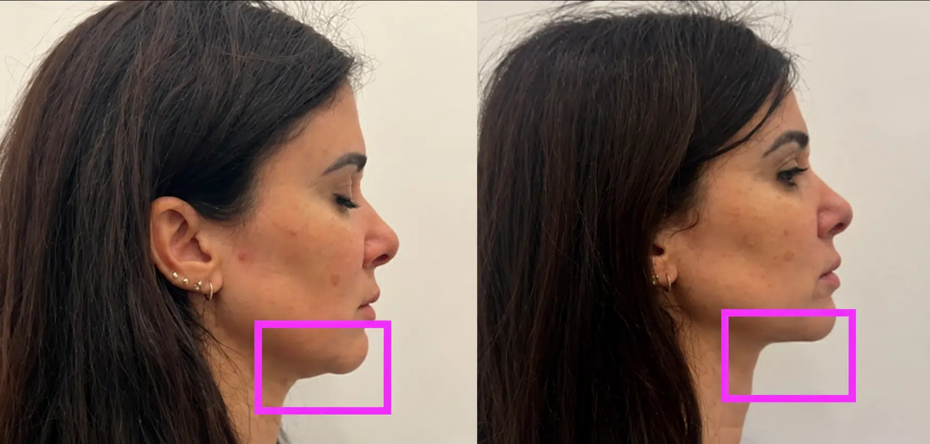 Cryolipolyse du double menton avant/après — Maison Marignan Paris