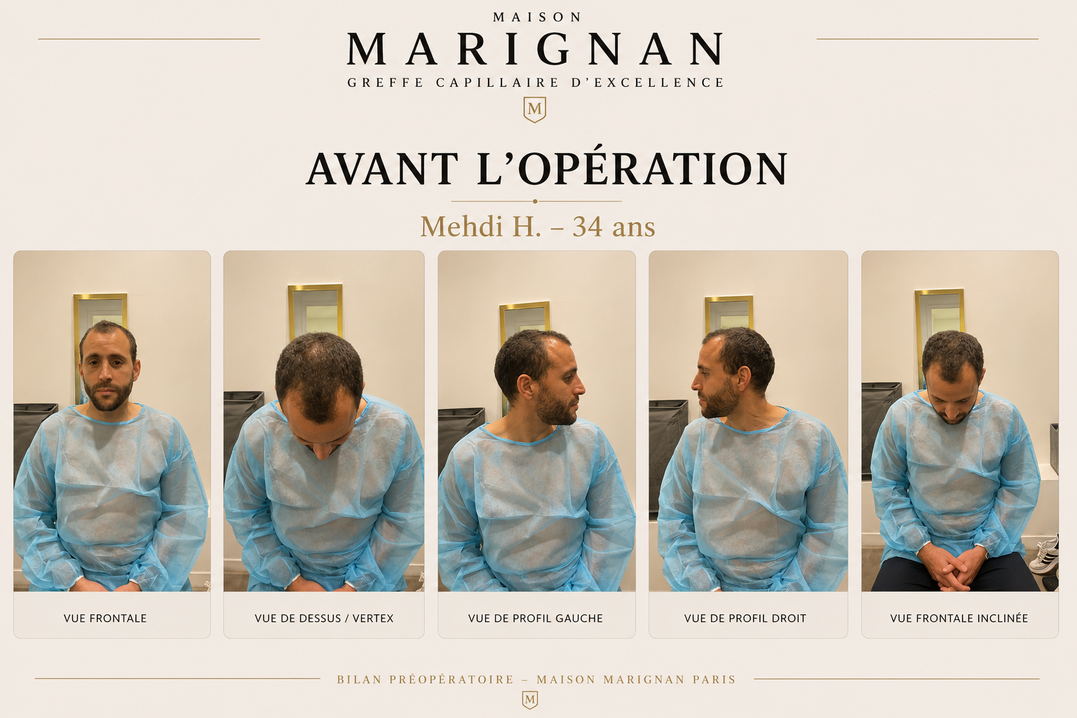 Résultat greffe de cheveux CHOI 1710 greffons à 12 mois — Maison Marignan Paris — avant