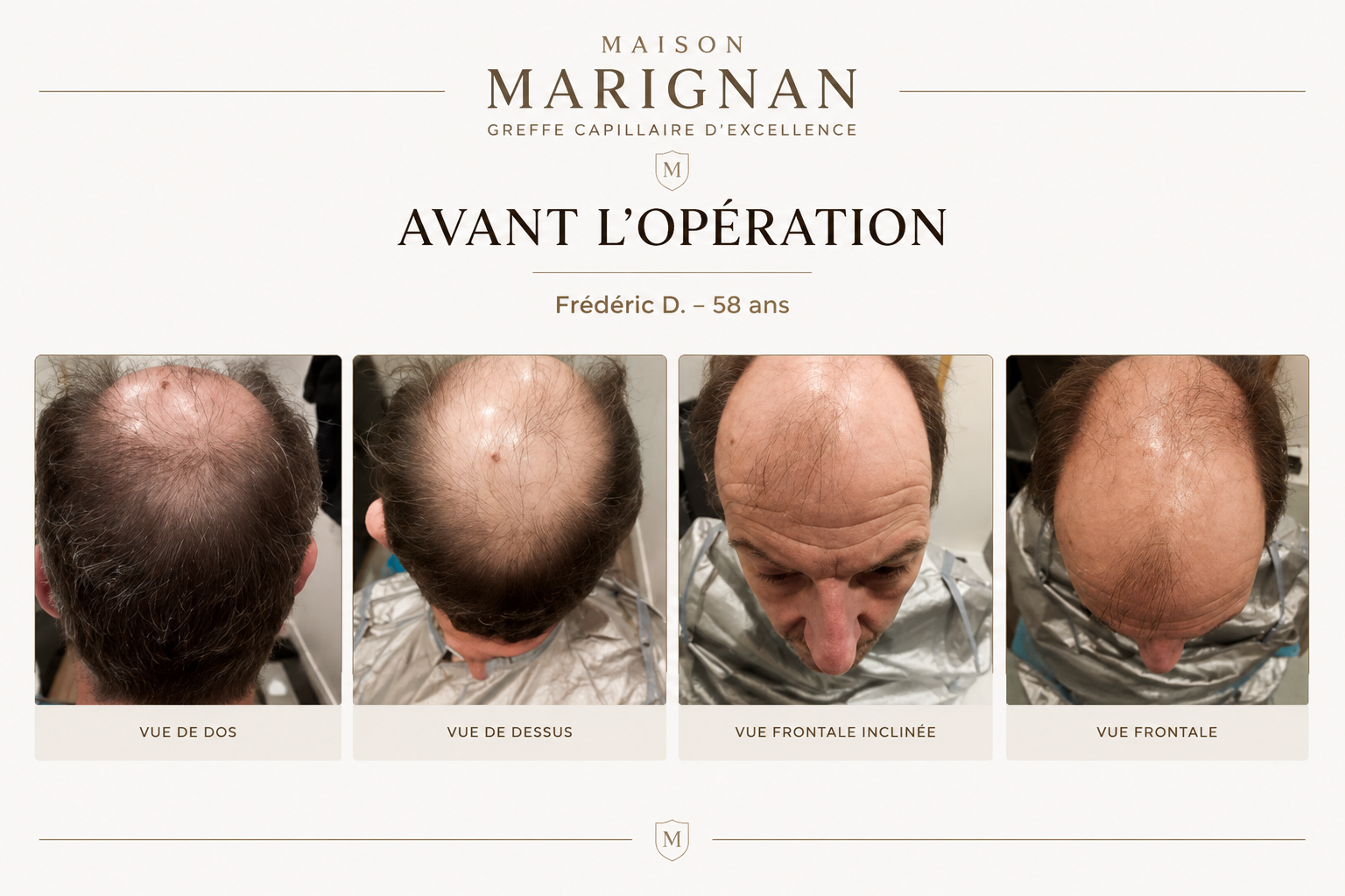 Avant après greffe capillaire CHOI 4578 greffons — Maison Marignan Paris — avant