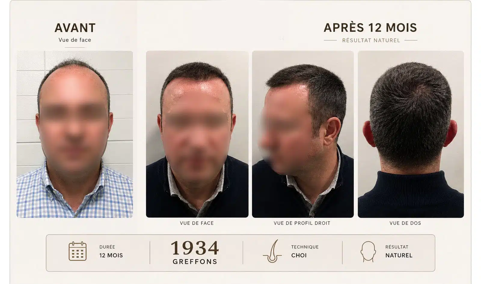 Résultat greffe de cheveux CHOI 1934 greffons, vue de face profil et dos — Maison Marignan