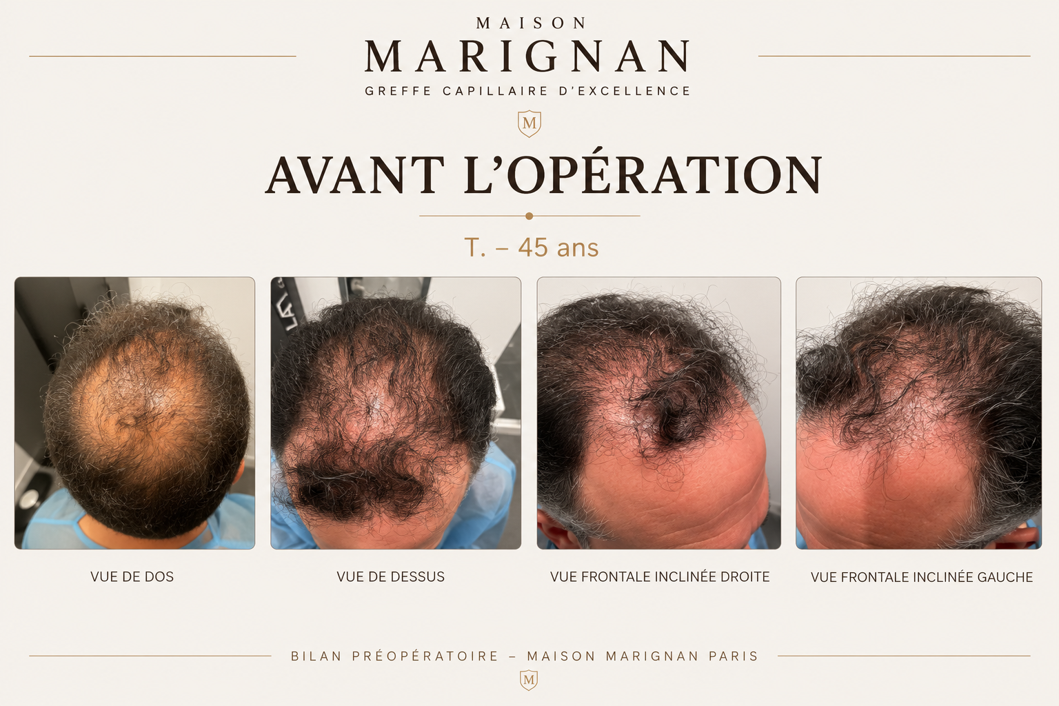 Avant après greffe de cheveux CHOI 3200 greffons — Maison Marignan Paris — avant