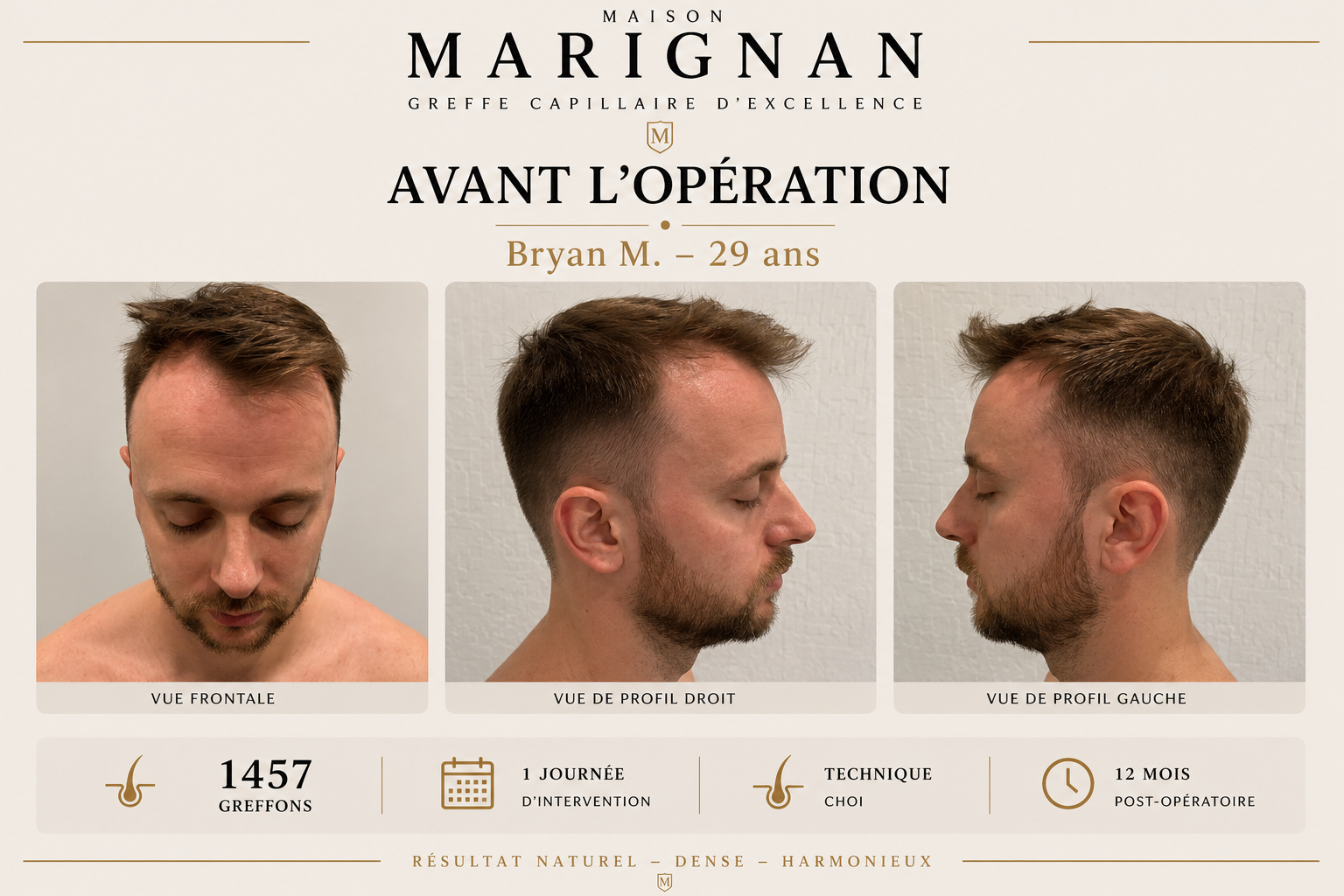 Avant après greffe de cheveux CHOI 1457 greffons — Maison Marignan Paris — avant