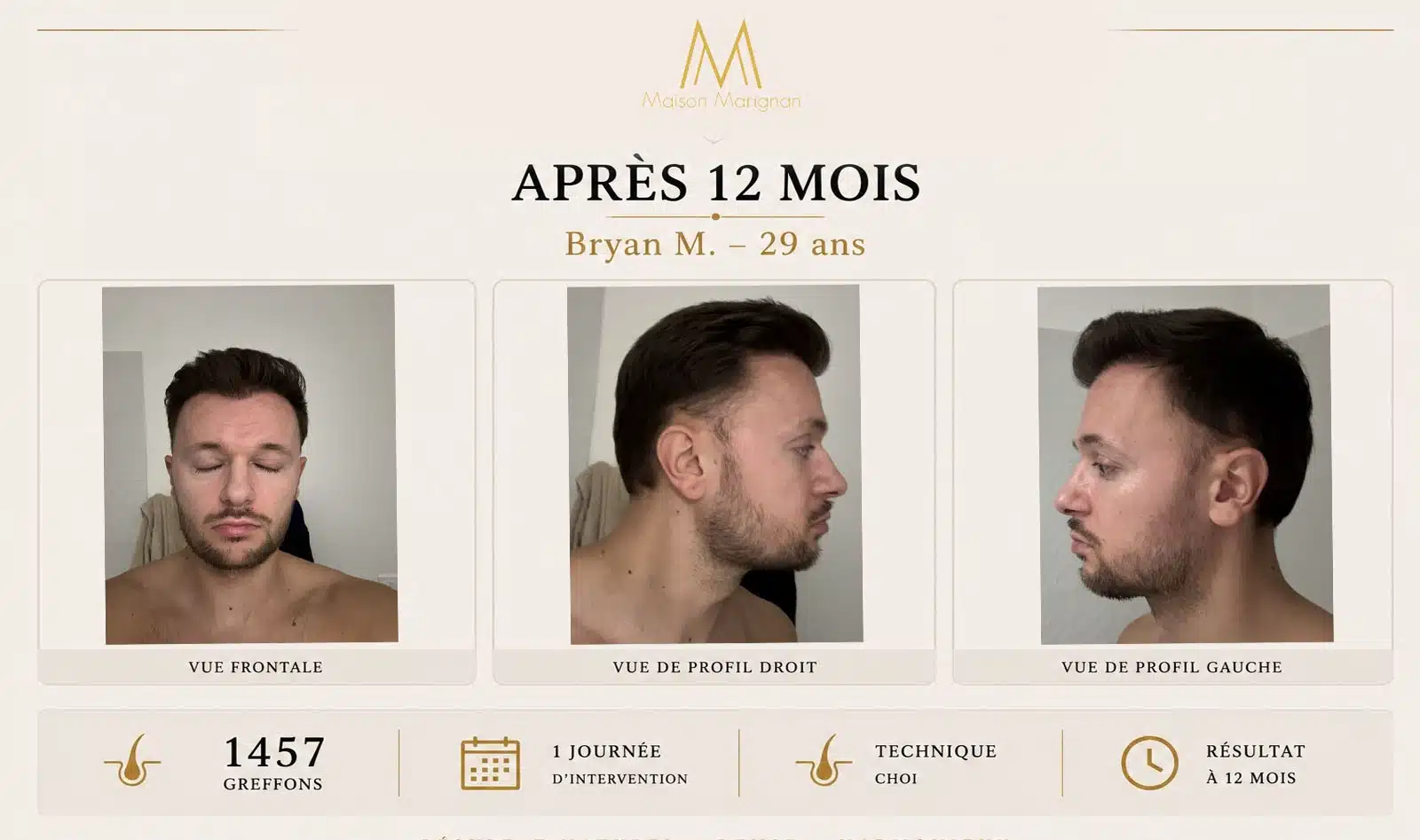 Avant après greffe de cheveux CHOI 1457 greffons — Maison Marignan Paris — après