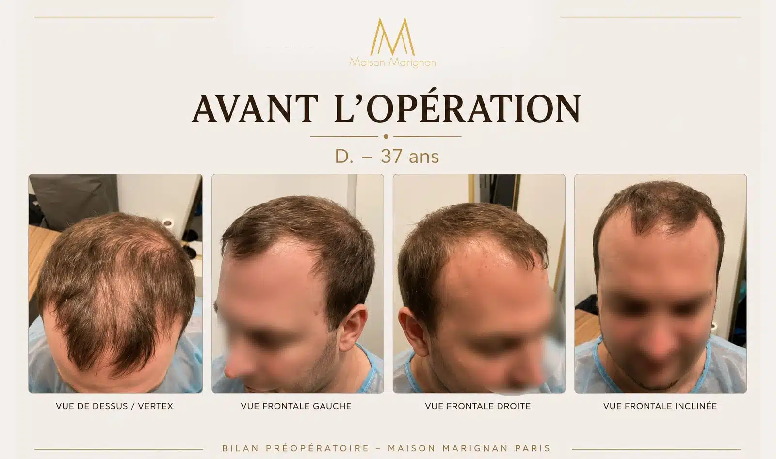 Avant après greffe de cheveux CHOI 1670 greffons — Maison Marignan Paris — avant
