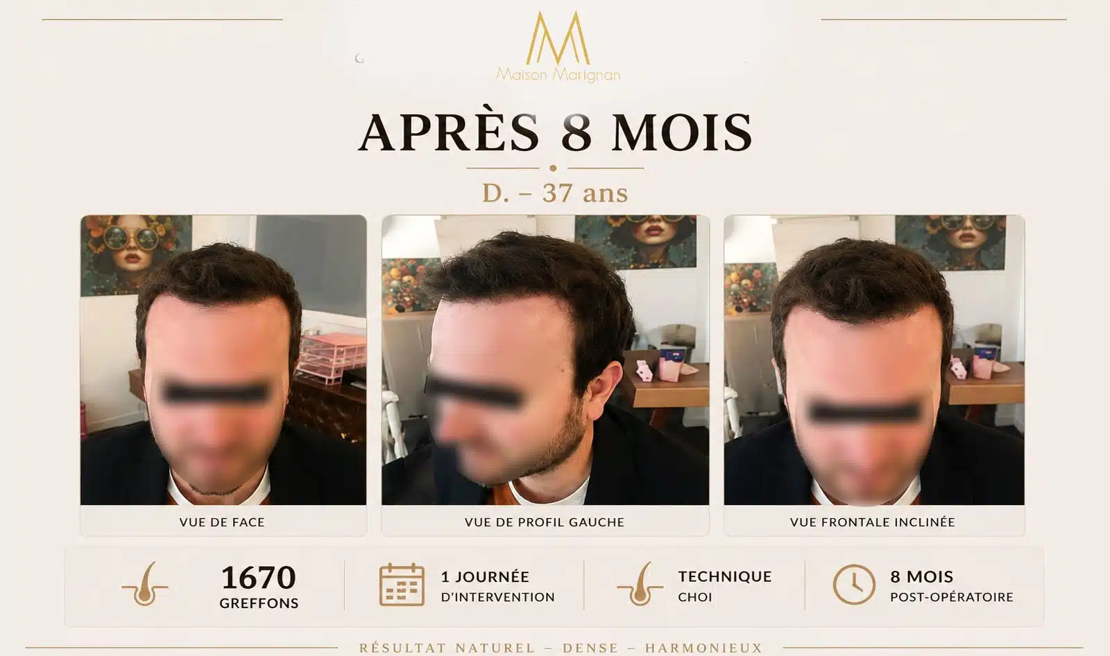 Avant après greffe de cheveux CHOI 1670 greffons — Maison Marignan Paris
