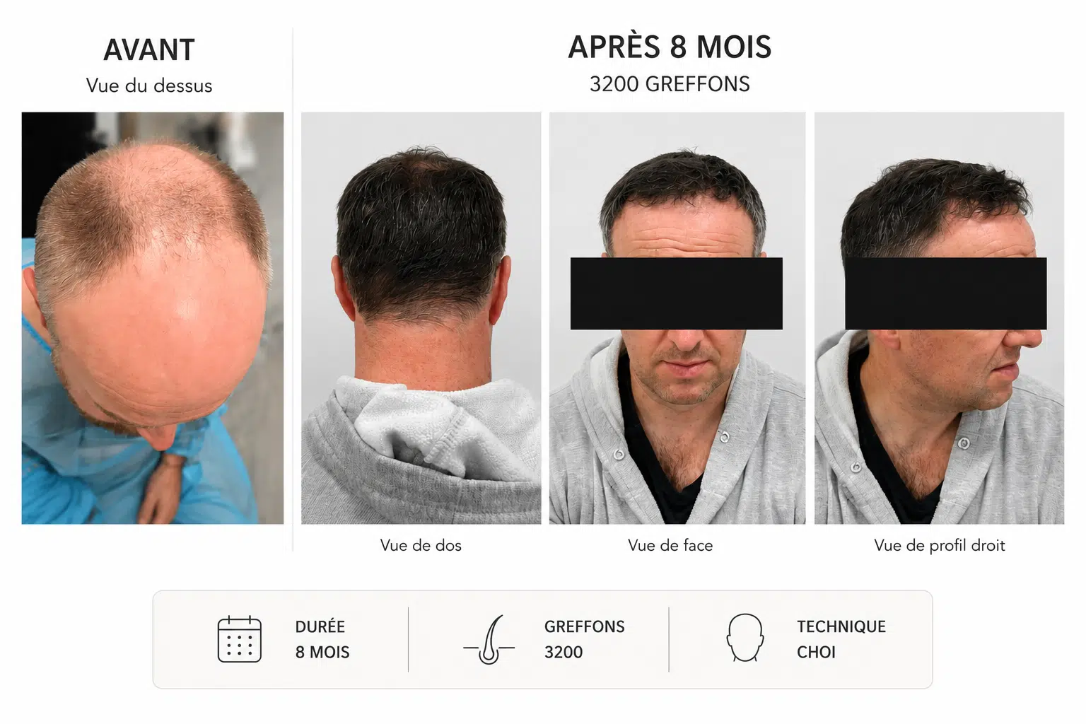 Avant après greffe de cheveux CHOI 3200 greffons, résultat à 8 mois — Maison Marignan Paris