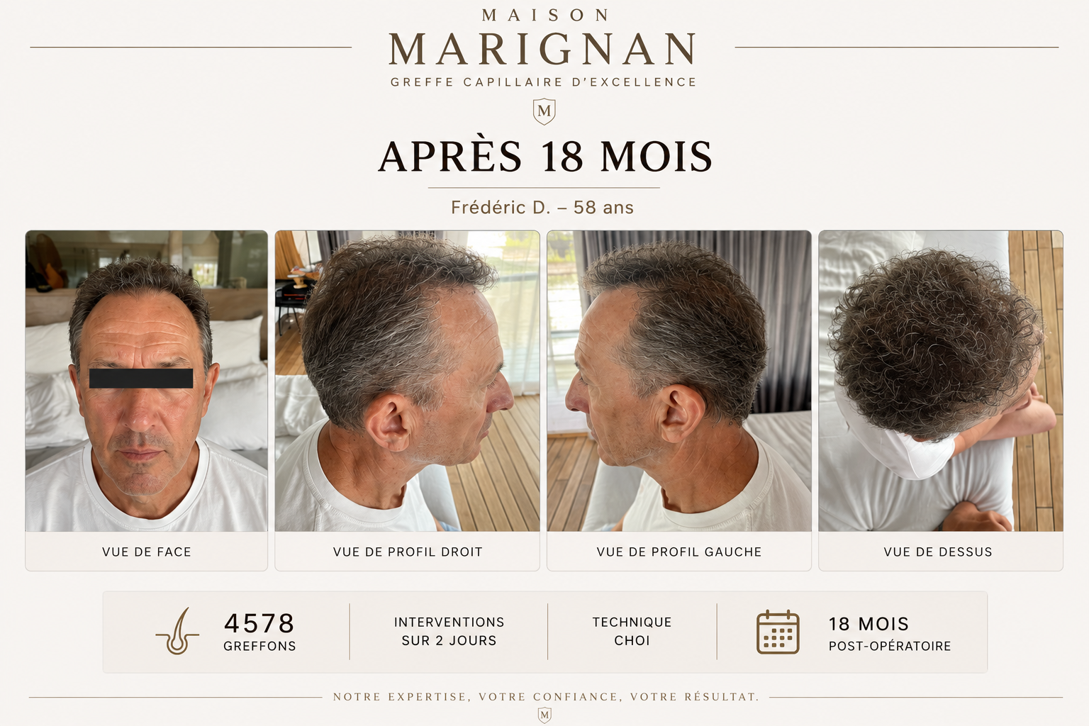 Avant après greffe capillaire CHOI 4578 greffons — Maison Marignan Paris