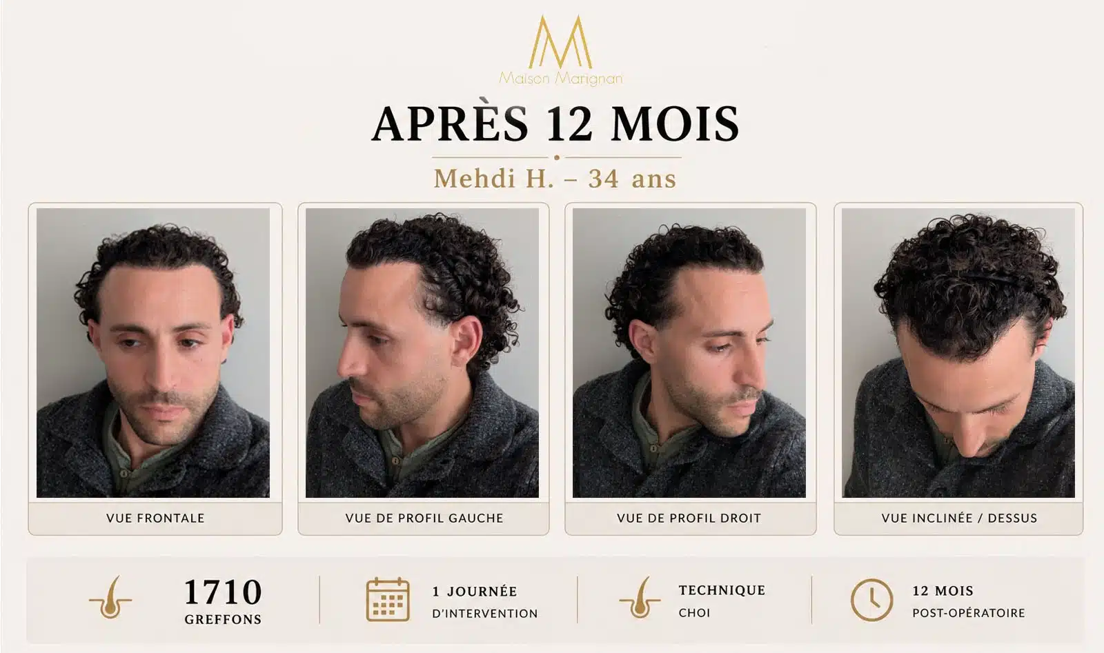 Résultat greffe de cheveux CHOI 1710 greffons à 12 mois — Maison Marignan Paris
