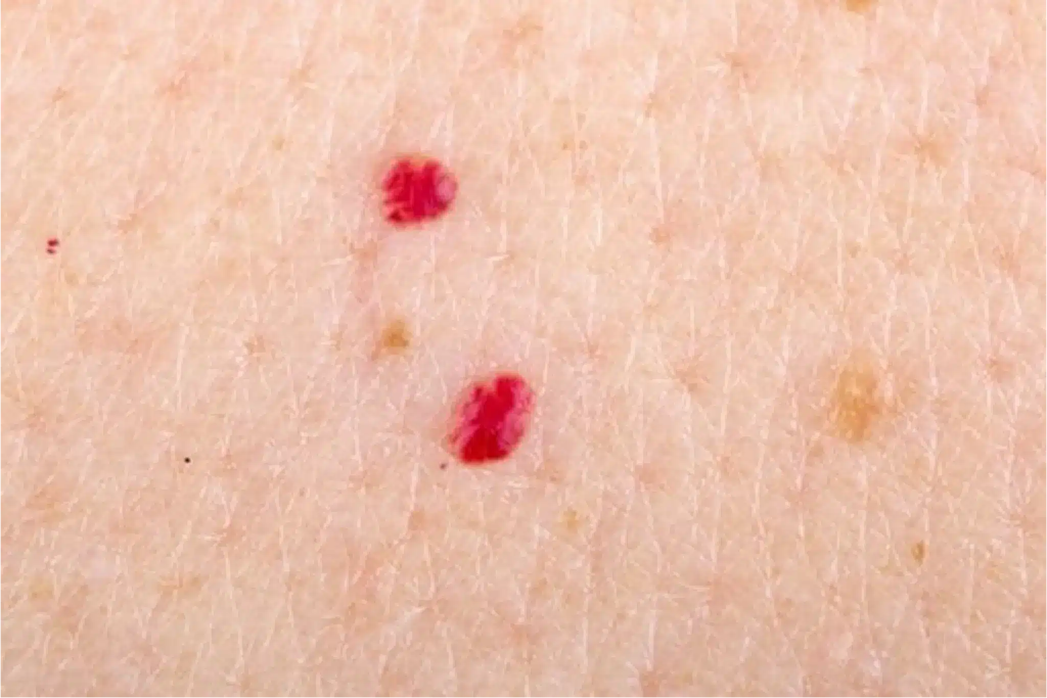Angiomes rubis — petits points rouges sur la peau