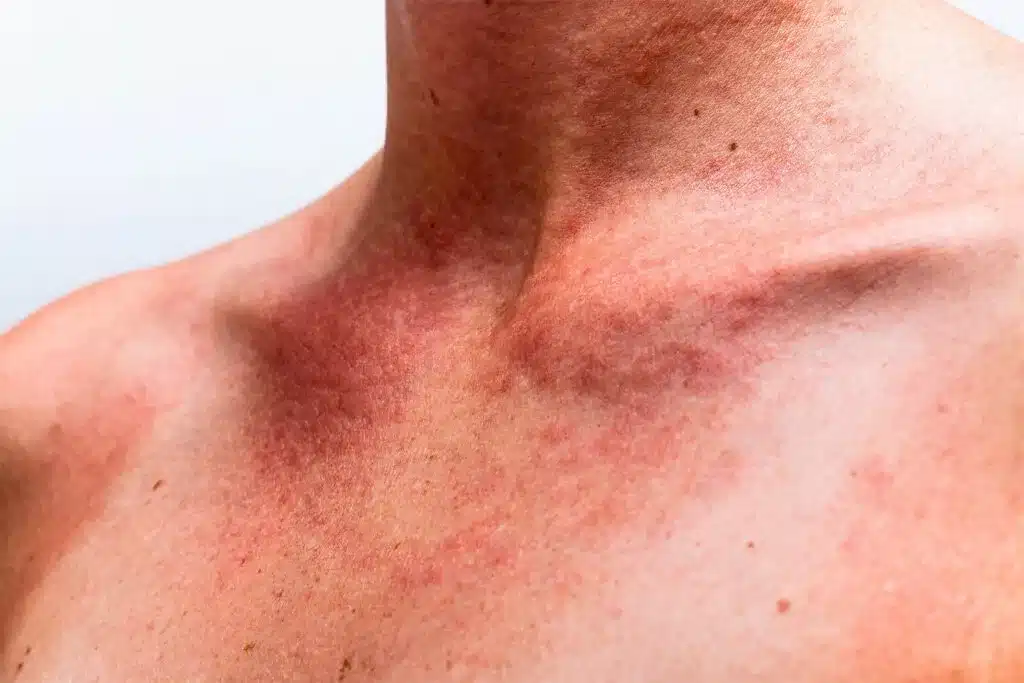 Rougeurs du cou et du décolleté — poïkilodermie