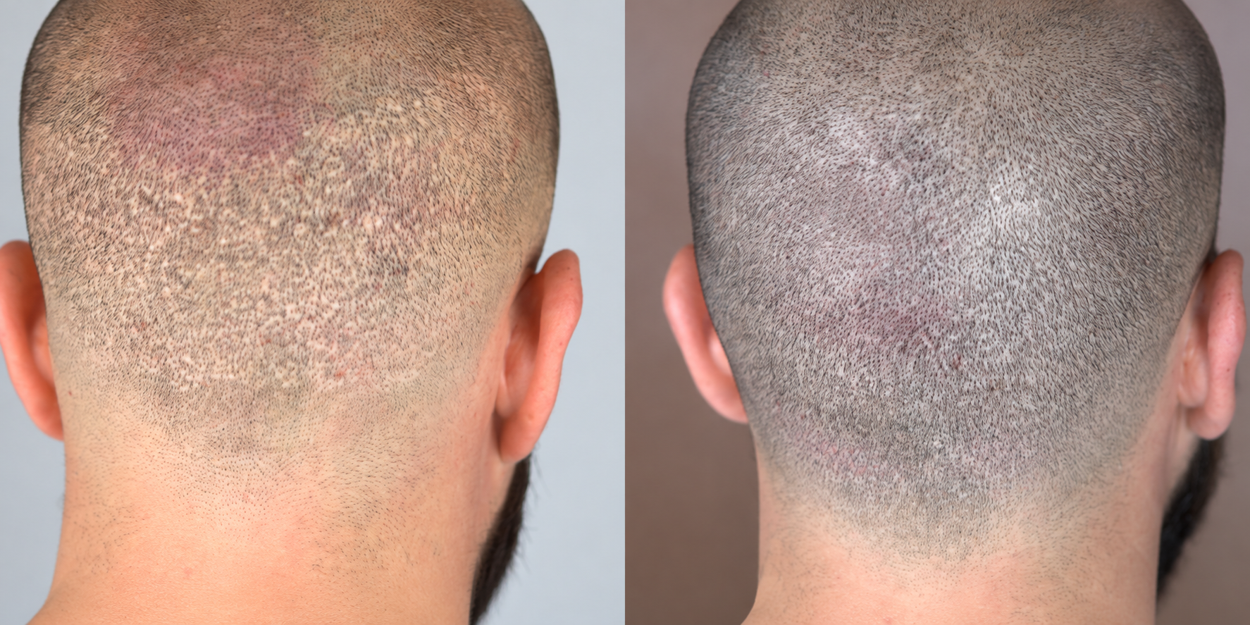 Avant / après : zone donneuse après greffe capillaire, densifiée par tricopigmentation